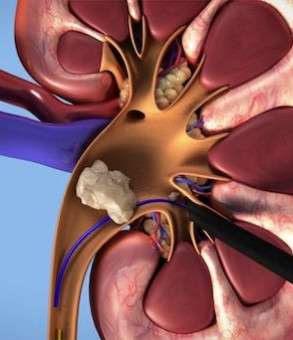 perkutan-nefrolitotomi