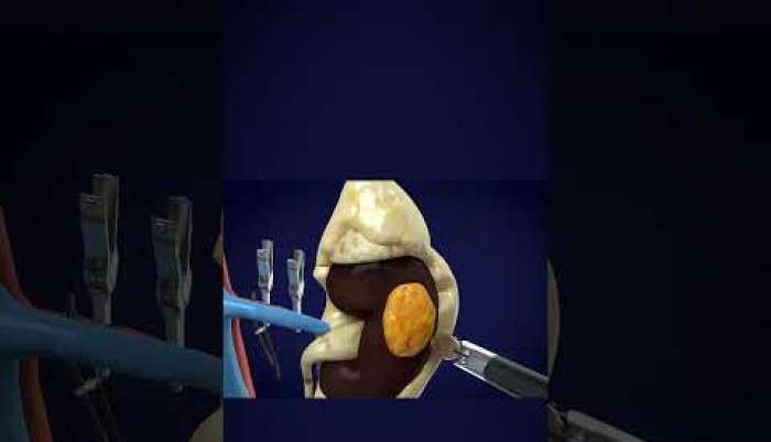 Sağlık,Hastalık,Tedavi,Üroloji,Ürolog,Uzman,hasta,hastane,ilaç,bilgi,ameliyat,hijyen,sağlıklı,doktor,mustafa kıraç,üroloji uzmanı,robotik cerrah,robotik cerrahi