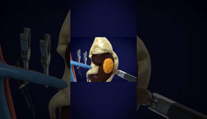 Sağlık,Hastalık,Tedavi,Üroloji,Ürolog,Uzman,hasta,hastane,ilaç,bilgi,ameliyat,hijyen,sağlıklı,doktor,mustafa kıraç,üroloji uzmanı,robotik cerrah,robotik cerrahi