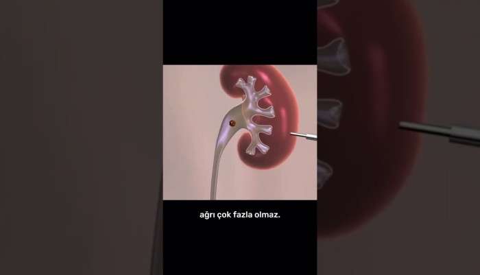 Sağlık,Hastalık,Tedavi,Üroloji,Ürolog,Uzman,hasta,hastane,ilaç,bilgi,ameliyat,hijyen,sağlıklı,doktor,mustafa kıraç,üroloji uzmanı,robotik cerrah,robotik cerrahi