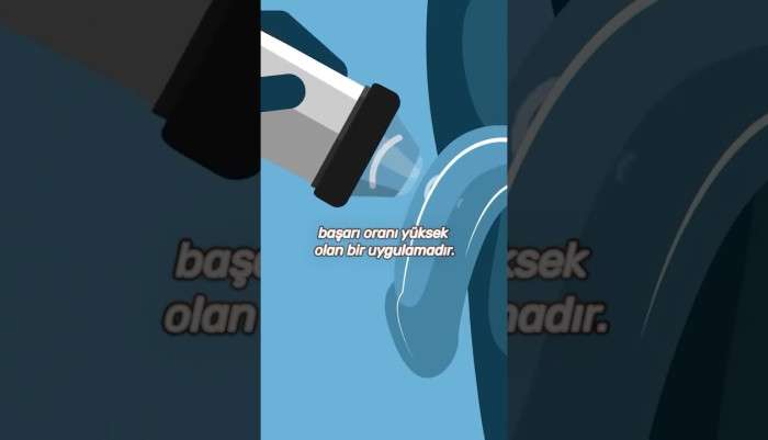 Sağlık,Hastalık,Tedavi,Üroloji,Ürolog,Uzman,hasta,hastane,ilaç,bilgi,ameliyat,hijyen,sağlıklı,doktor,mustafa kıraç,üroloji uzmanı,robotik cerrah,robotik cerrahi,eswt tedavisi