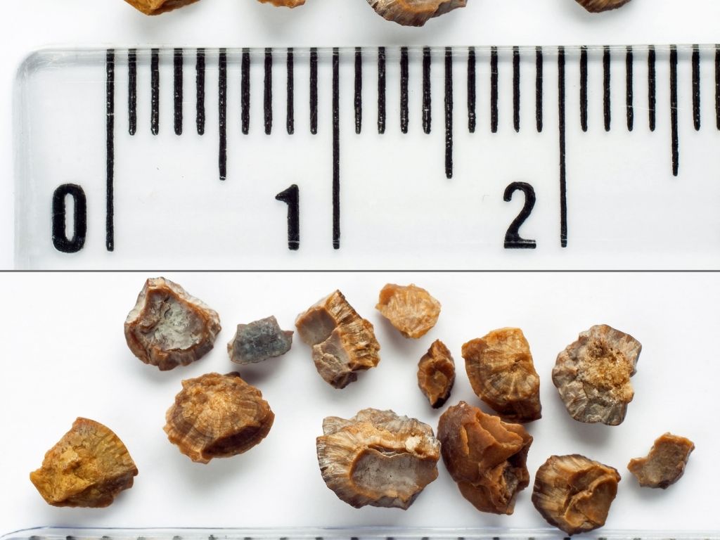 Does Beer Help Pass Kidney Stones?